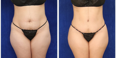 Woman treated with Tummy Tuck, Liposuction, Renuvion - Woman treated with Tummy Tuck, Liposuction, Renuvion