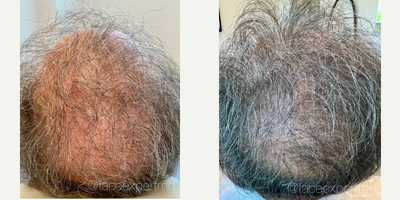 55-64 year old man treated with Hair Loss Treatment - 24K Gold Hair Treatment by Dr. Arash Moradzadeh
