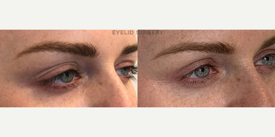 Woman treated with Ptosis Surgery - Dr. Maleki performed a revisional upper lid blepharoplasty to lower the right upper lid, raise the left upper lid and remove the extra folds to create a single, well-positioned and most importantly symmetric upper lid crease.