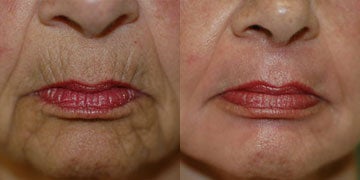 cosmelan peel chemical before realself
