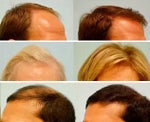 Hair Loss Treatment Overview