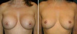 Breast Implant Removal Guide: Frequently Asked Questions