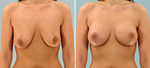 Choosing the Right Doctor for Your Breast Augmentation: 20 Essential Questions to Ask at a Consultation