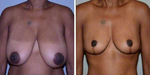 Breast Reduction: Frequently Asked Questions