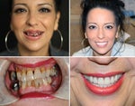 Dental Implants Guide: Top Questions & Answers