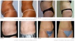 UltraShape® Overview: Here’s What You Need to Know