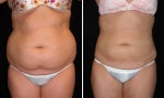 An overview of everything you need to know about liposuction and its alternatives.