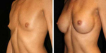 Breast Implants Guide: Frequently Asked Questions