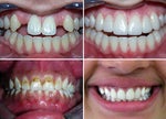 Porcelain Veneers Guide: Top Questions & Answers