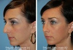 Rhinoplasty before and after photo
