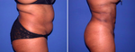 Liposuction Guide: Top Questions & Answers