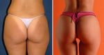 Brazilian Butt Lift Guide: Frequently Asked Questions