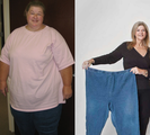 Gastric Bypass Before and After