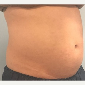 What are the flanks, and why is it so hard to get rid of fat there? -  Cosmetic Enhancement Center of New England