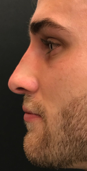 Wassim Taktouk Mbbs Reviews Before And After Photos Answers Realself He is known for his light handed touch and his ability to achieve sophisticated and natural results. wassim taktouk mbbs reviews before