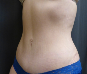 Warren Schutte Md Reviews Before And After Photos Answers