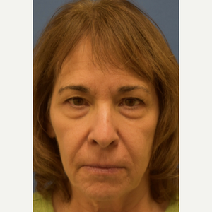Anthony J Wilson Md Reviews Before And After Photos Answers Realself