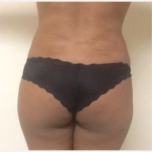 Downey Liposuction Centers - Amazing results from female patient