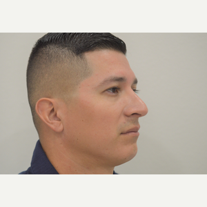 Carlos Ayala Md Facs Reviews Before And After Photos Answers Realself