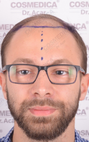Levent Acar Md Reviews Before And After Photos Answers Realself