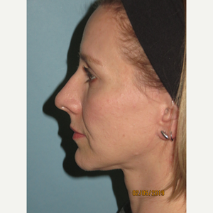 Sean T Lille Md Reviews Before And After Photos Answers Realself Bill lawrence says this is because each episode is dr. sean t lille md reviews before and