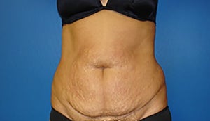 Stanley Okoro Md Reviews Before And After Photos Answers Realself