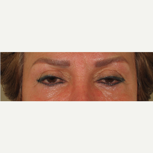 How to Reduce the Bags Under Your Eyes: Rostami OPC: Oculofacial