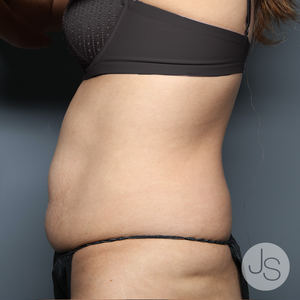 Can You Walk Right Away After Liposuction On Thighs? - Jaime Schwartz MD,  FACS