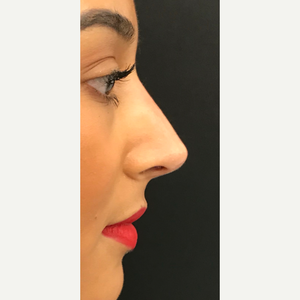 Wassim Taktouk Mbbs Reviews Before And After Photos Answers Realself With dr wassim taktouk | trinny podrobnee. wassim taktouk mbbs reviews before