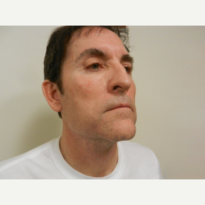 Gregory A Wiener Md Facs Reviews Before And After Photos Answers Realself