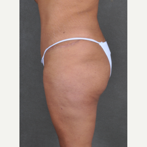 Brazilian Butt Lift Omaha (BBL) - Omaha Liposuction by Imagen