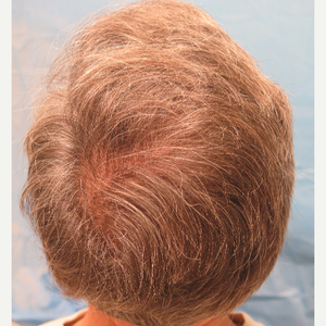 Michael Wolfeld Md Reviews Before And After Photos Answers Realself