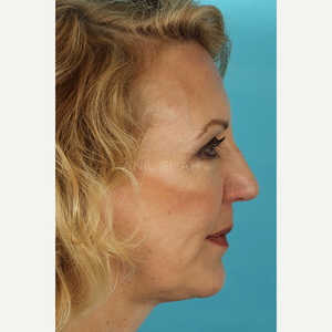 Deep Neck Lift, Dr. Anil Shah, Shah Aesthetics, Chicago, IL