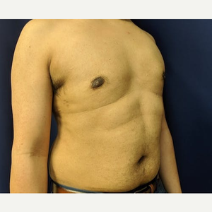 https://fi.realself.com/300/6/a/0/Gynecomastia-Surgery-after-11850433-5050356.jpg