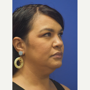Michael Diaz Md Facs Reviews Before And After Photos Answers Realself