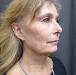 Warren Schutte Md Reviews Before And After Photos Answers
