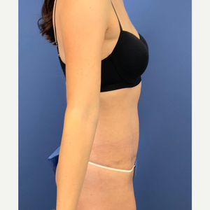Recovery After Liposuction - Dr. York Yates Plastic Surgery