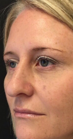 Wassim Taktouk Mbbs Reviews Before And After Photos Answers Realself He is known for his light handed touch and his ability to achieve sophisticated and natural results. wassim taktouk mbbs reviews before