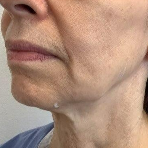 Prevent Text Neck  Neck Rejuvenation by Dr Ron Shelton