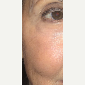 Ann Jayaram Md Reviews Before And After Photos Answers Realself She completed an ophthalmology residency in all types of eye care and surgeries including comprehensive eye exams, cataract surgery, glaucoma procedures, and laser treatments. ann jayaram md reviews before and