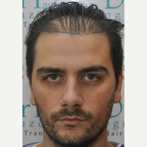 Tayfun Oguzoglu Md Reviews Before And After Photos Answers Realself