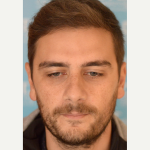 Tayfun Oguzoglu Md Reviews Before And After Photos Answers Realself
