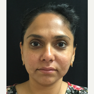 Michele S Green Md Reviews Before And After Photos Answers Realself Fellowship, brigham and women's hospital. michele s green md reviews before