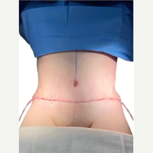 How Much Is A Tummy Tuck? - Millennial Plastic Surgery