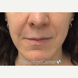 Lip Fillers  The Spiegel Center