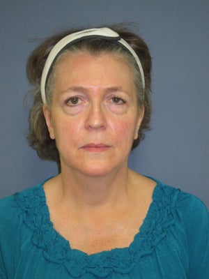 Chad K Wheeler Md Reviews Before And After Photos Answers Realself