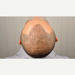 Koray Erdogan Md Reviews Before And After Photos Answers Realself