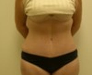 Tummy Tuck Columbia, SC