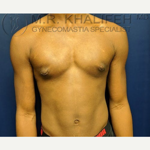 Laser Liposuction Touch Ups