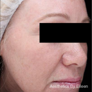 Aesthetics By Eileen Laser Skin Care Medical Spa Raleigh Raleigh North Carolina Realself